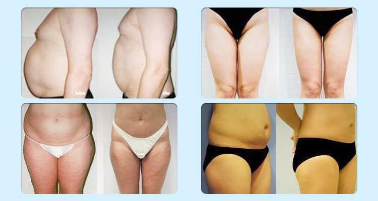 Weight Reduction RF Cavitation Slimming Machine Skin Tightening Beauty Machine
