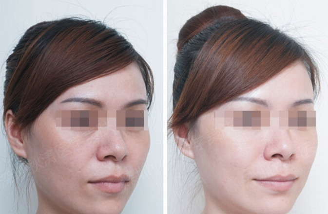 Whitening Youth Serum Injection Mesotherapy Skin Care Vitamin C Serum