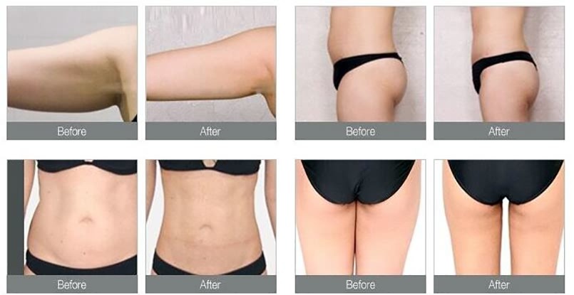 Vacuum Rf Rolling 110v Slimming Machine Cellulite Fat Removal Massage