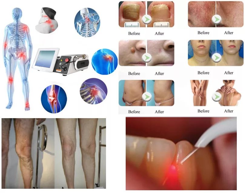 980nm 1470nm Diode Laser Lipolysis Machine For Beauty Center