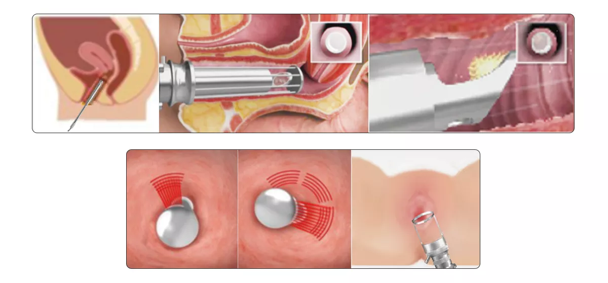 Women medical equipment fractional CO2 laser machine vaginal rejuvenation equipment