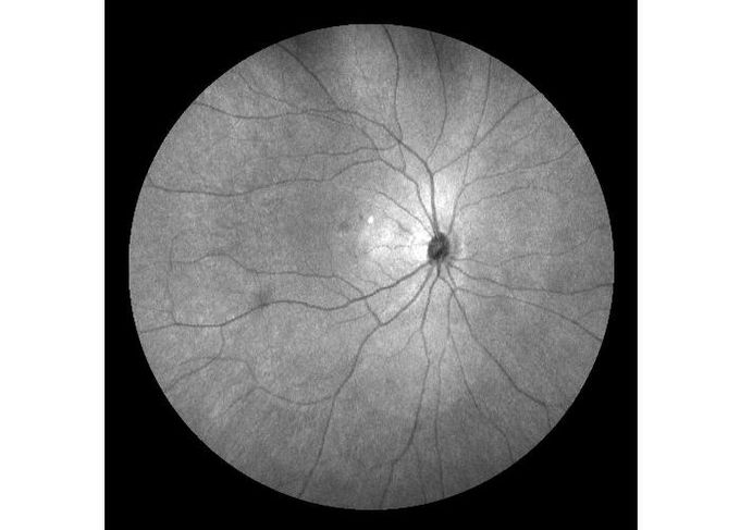 Ultra-wide Field Laser Scanning Retina Angiograph Digital Ophthalmic Equipment With Optical Zoom 100°/60°/30°