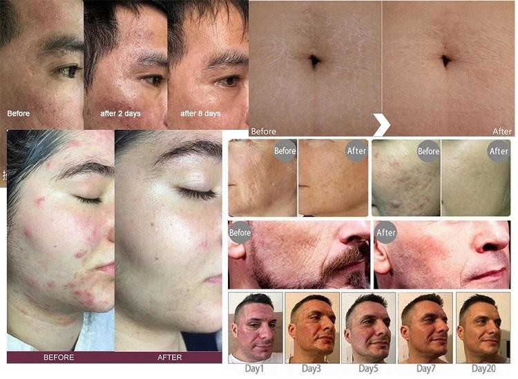 50000 Shots RF Microneedling Machine Pigment Removal CE ISO Approval