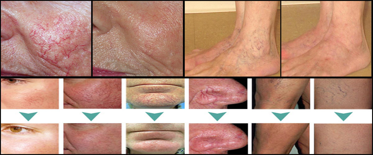 Spider vein laser removal varicose veins laser treatment machine