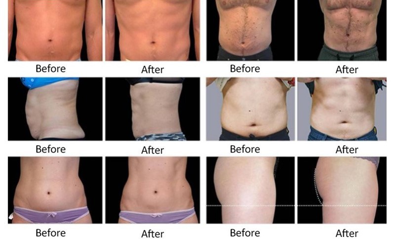 360 Degree Working Cryo Weight Loss Machine Body Sculpting And Reduce Fat