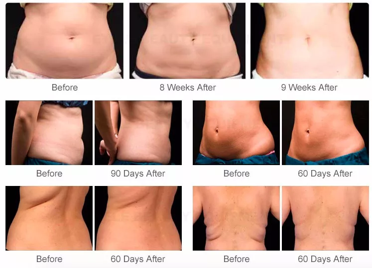 9 In 1 Ultrasound Cavitation Slimming Rf Lipo Laser Fat Burning Cavitation Machine