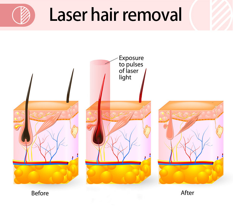 Facial Body 808nm Diode Laser Machine Hair Removal Macro Channel 10 Bars Triplewaves