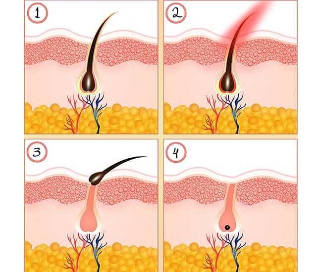Permanent Hair Remover 755nm 808nm 1064nm Diode Laser Hair Removal Machine Epilation Definitive