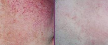 High Frequency Non-Invasive Facial Vein Removal Treatment Machine 30MHz