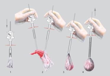 CFDA Laparoscopic Specimen Retrieval Bag , Tissue Retrieval Bag
