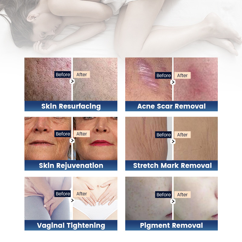 Winkle Removal Fractional Co2 Laser Equipment For Professional Beauty Salon