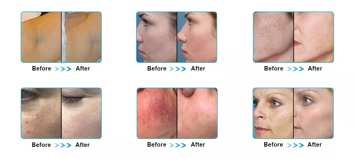 Portable Ipl Opt Shr Shr Opt E Light Handset Lamp Handle Laser Ipl Hair Removal Hair Removing Machine