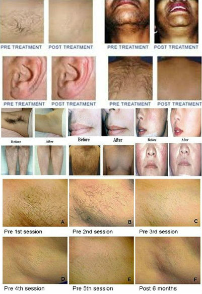 TOP Performance device !!!ipl rf machine hair removal machine for sale,the best price