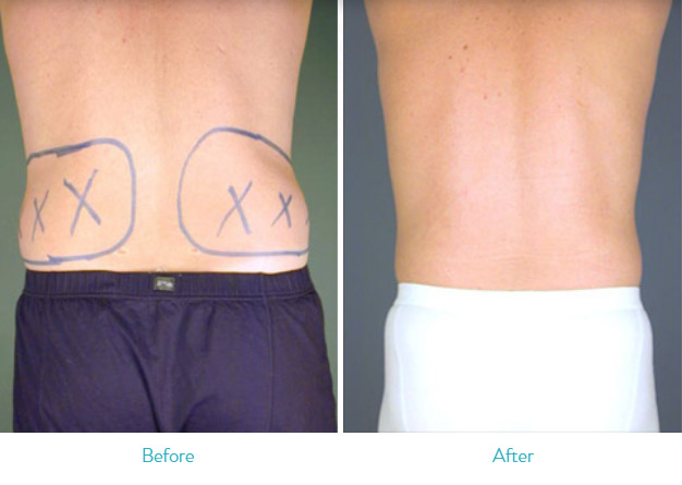 Flank Surgical Liposuction Machine For Fat Reduction / Body Shaping
