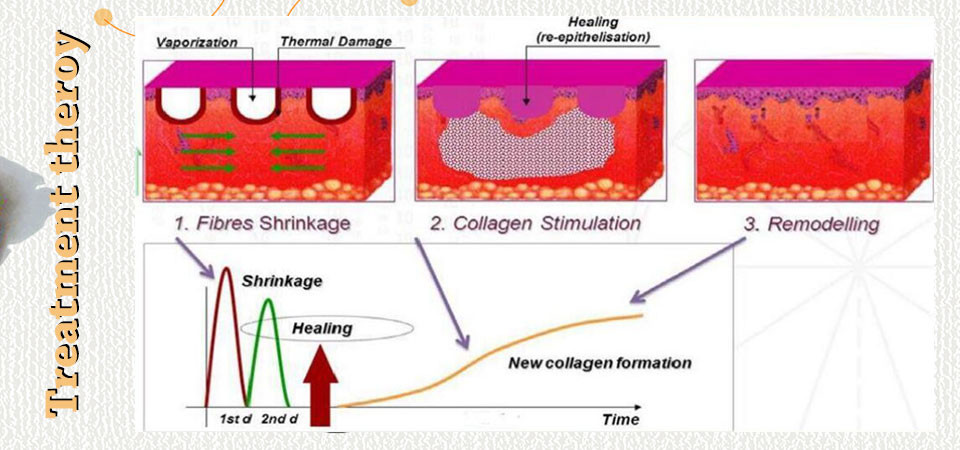 Professional 5000hz Co2 Fractional Laser Machine Ce