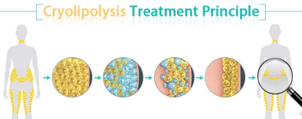 Cryolipolysis-Treatment-Principle.jpg
