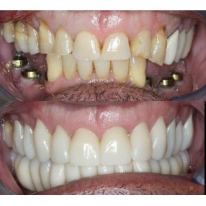 Yucera 4D Pro Zirconia Block for Professional Dental Labs, with Multiple