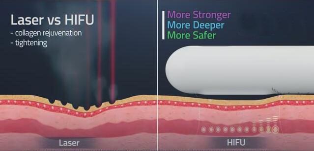 Non Surgical Hifu Cellulite Reduction Machine Face Lifting Body Firming Vaginal Tighten
