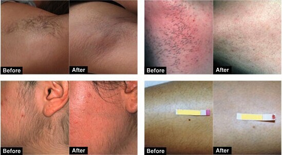 IPL hair removal machine skin rejuvenation machine ipl xenon flash lamp