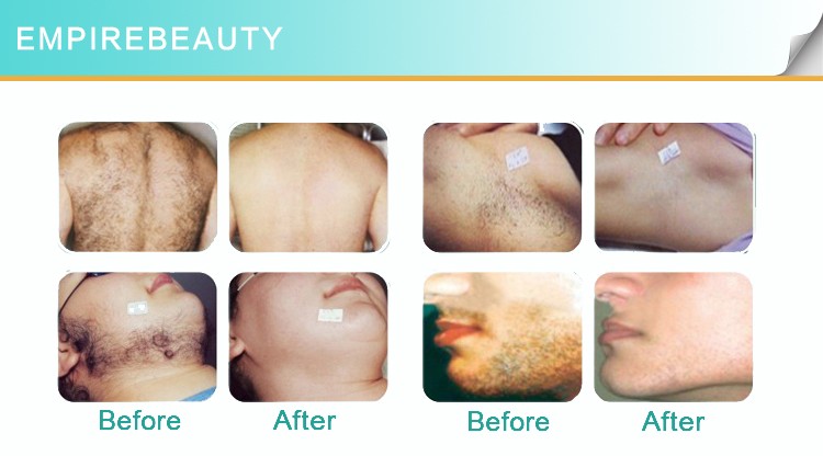Portable SHR E-light Hair Removal Skin Rejuvenation