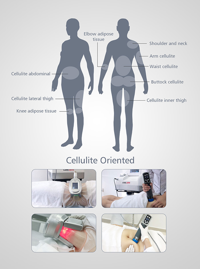 Cryolipolysis Fat Freezing Machine Cryolipolysis With Shock Wave 2 In 1 Machine Therapy