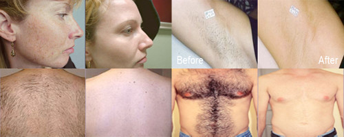 IPL hair removal machine skin rejuvenation machine ipl xenon flash lamp