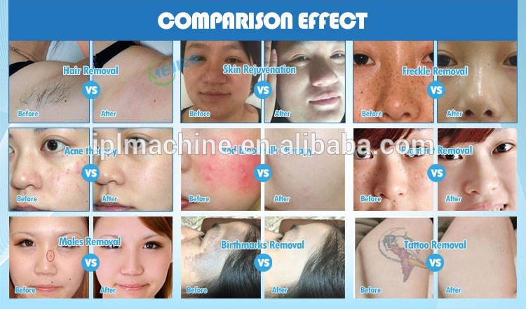 2017 Hottest 4 in 1 multifunctional ipl elight rf nd yag laser beauty apparatus