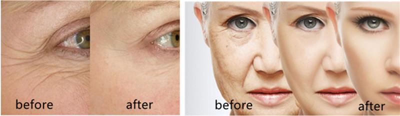 Body Collagen Induction 220V Microneedling Fractional RF
