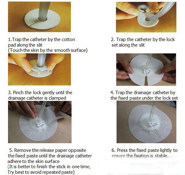 Disposable Drainage Catheter Fixation Devices