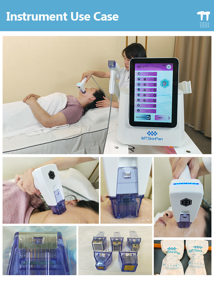 Professional White Microneedling Machine With Single Handle Operation