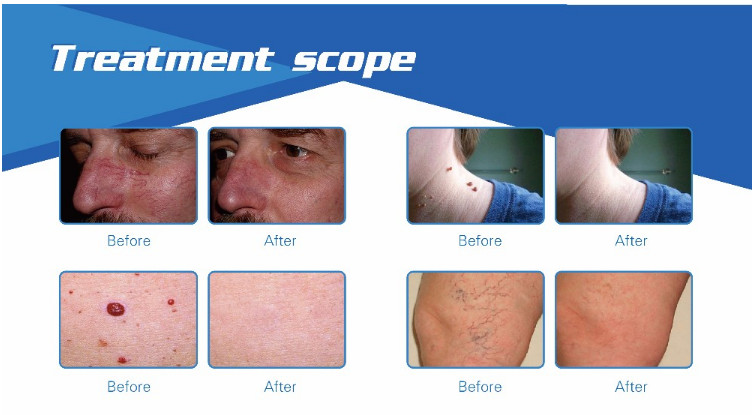 2018 Newest invention painless 980nm laser spider vein / vascular removal machine