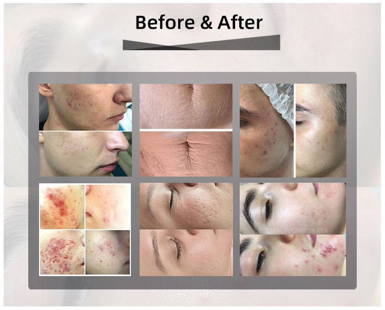 OEM Skin Care Resurfacing Co2 Fractional Laser Machine 10600nm