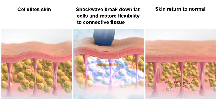 ESWT Shockwave Therapy for Penile Enhancement