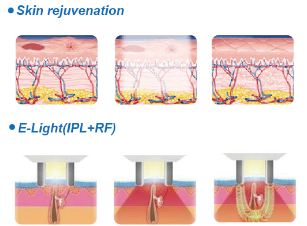 FDA approved ipl laser machine ipl laser hair removel machine for sale lumenis ipl quantum