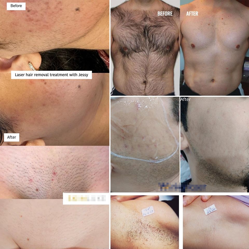Portable Diode Laser Machine Hair Removal Machine Price 1200w 1000w