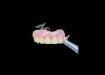 Easy Fit Cast Partial Denture Restores Chewing And Speaking Ability