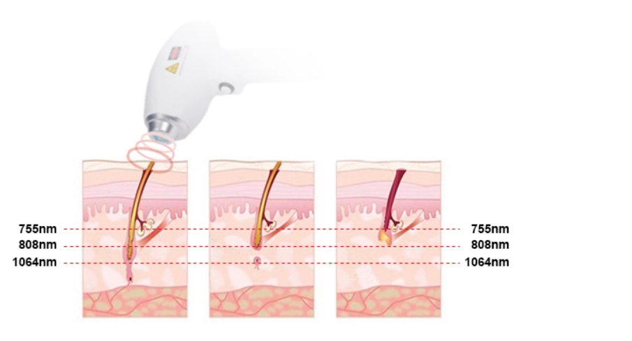 Diode Laser Beauty Equipment 755 808 1064 Hair Removal Skin Rejuvenation