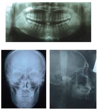 4 - 10 mA Digital Panoramic Dental X Ray Machine Medical X Ray Machine