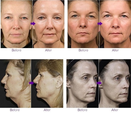 Portable 5mhz Radio Frequency Rf Micro Needling For Anti - Wrinkle Treatment