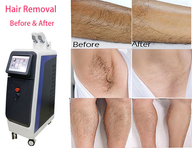 950nm IPL Hair Removal Machine