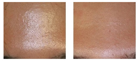 Oily Youth Serum Injection ‏Oil Control Mesotherapy Skin Treatment