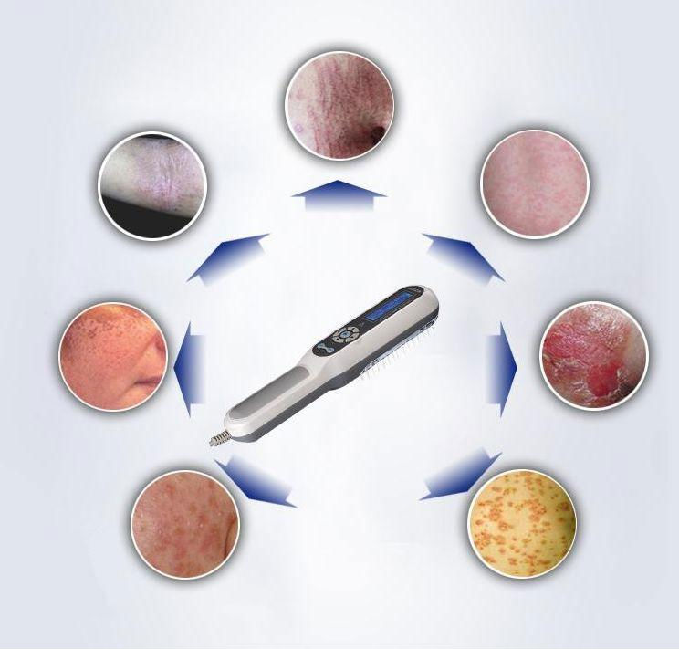Hand Held UV Phototherapy for Vitiligo and Psoriasis / Special UV Lamp with Factory Price