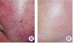 High Frequency Non-Invasive Facial Vein Removal Treatment Machine 30MHz
