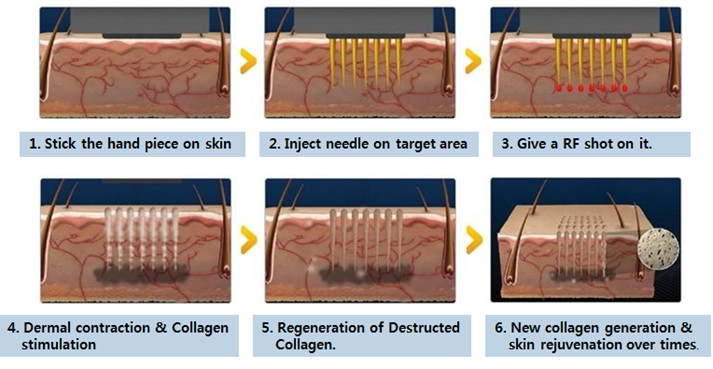 Skin maintenance microneedle nurse system Fractional radiofrequency micro needling