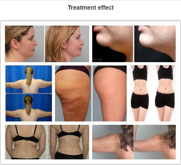 CoolSculpting Cryolipolysis Body Slimming Machine / Fat Reduction Equipment Painless