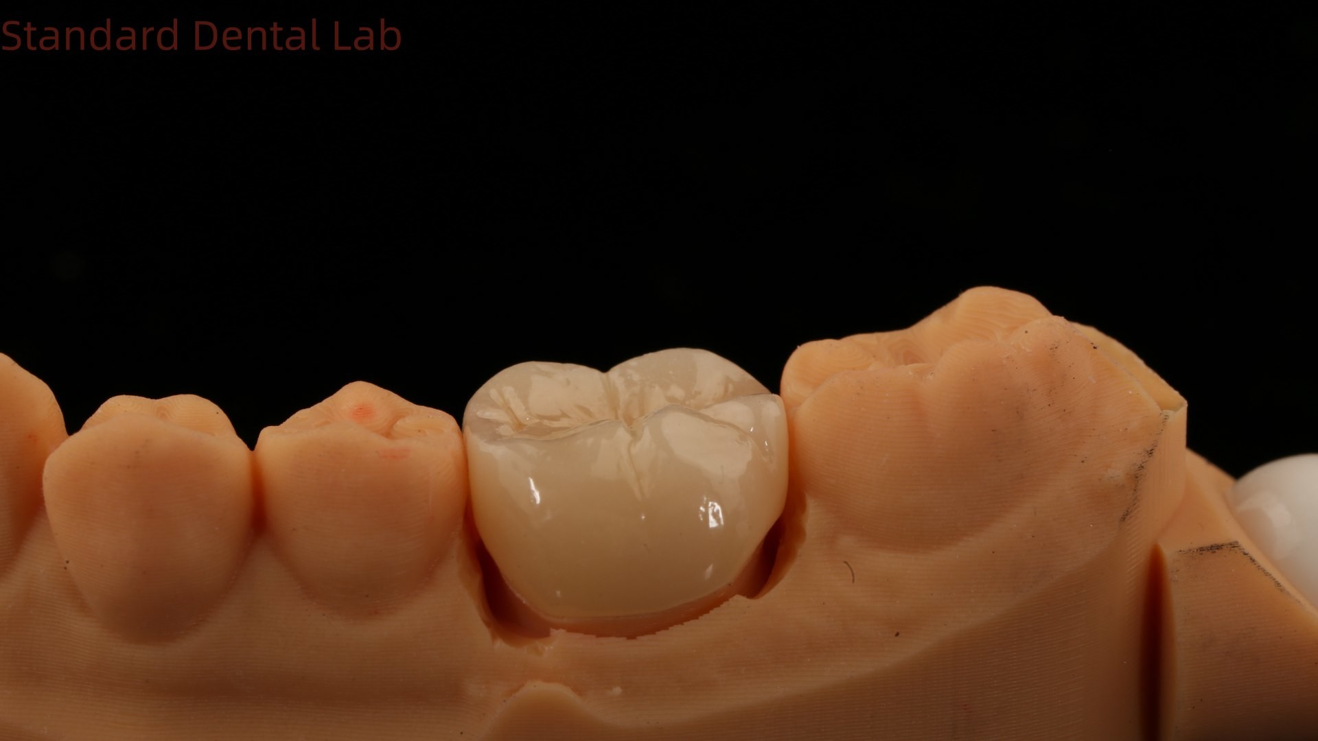 Dental Digital Full Zirconia Crown with Noritake Porcelain 3D Print Model 5 Year Guarantee