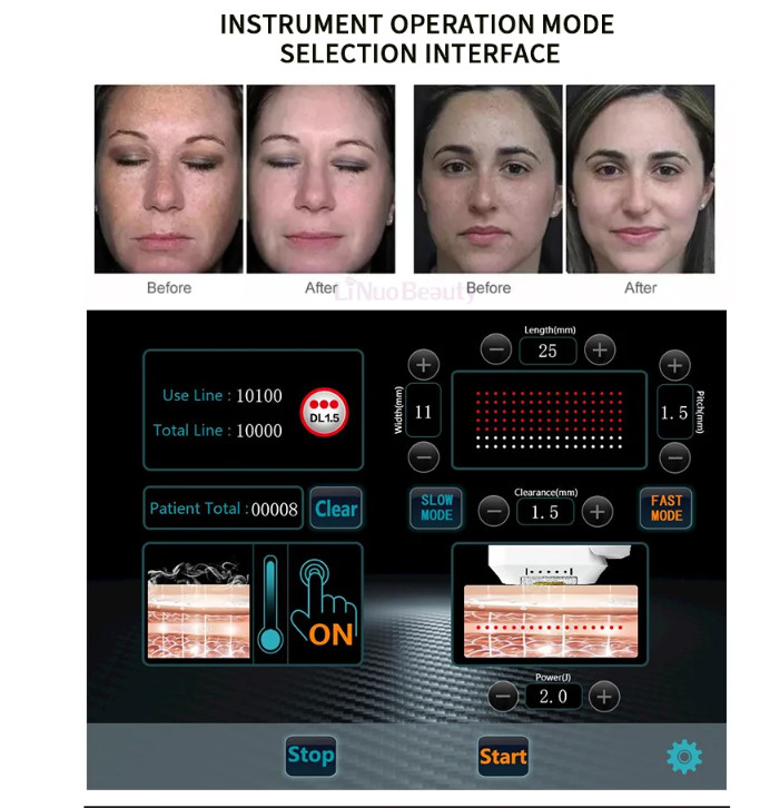 12D CRYOHIFU Hifu Facial Machine For Skin Tightening And Lifting With Hifu Ultrasound Technology
