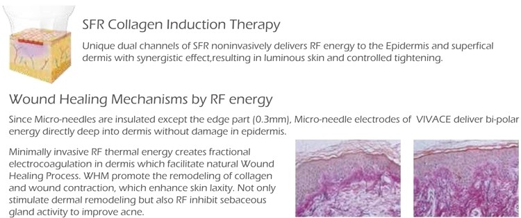 Fractional RF Microneedle radio frequency machine microneedle mesotherapy skin resurfacing rf microneedle machine