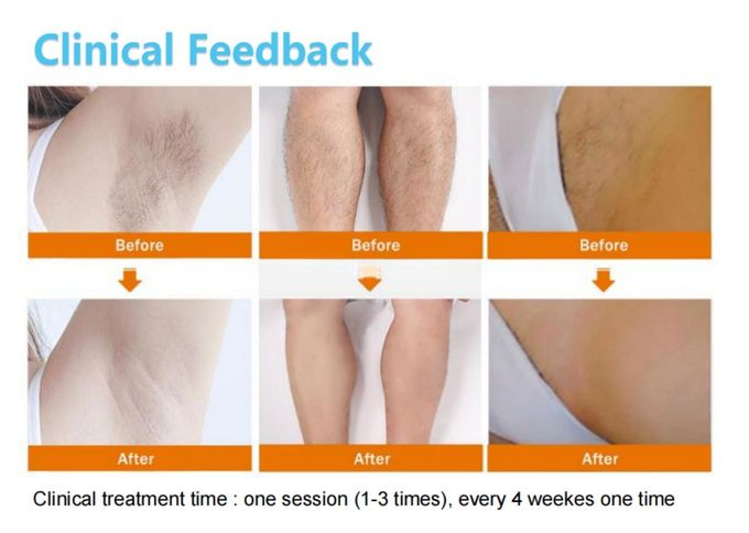 Fast and Efficient Diode Laser Hair Removal Machine for Men and Women 0