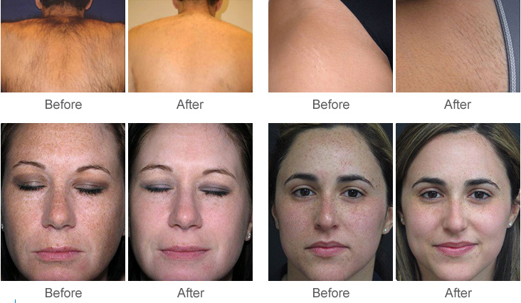 Hot selling new design 2 handles SHR OPT IPL/ipl laser/IPL hair removal